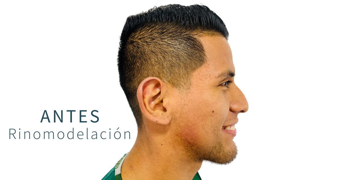 After-Rinomodelación