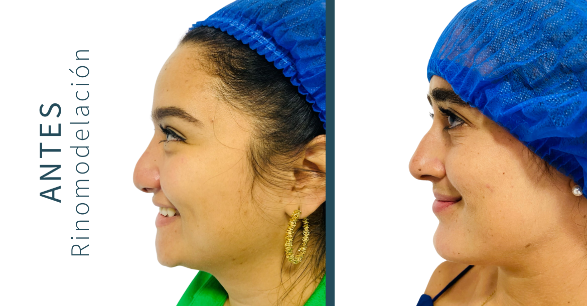 After-Rinomodelación