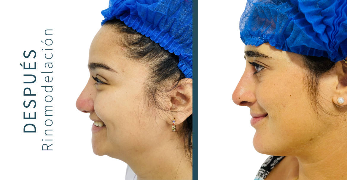 Before-Rinomodelación