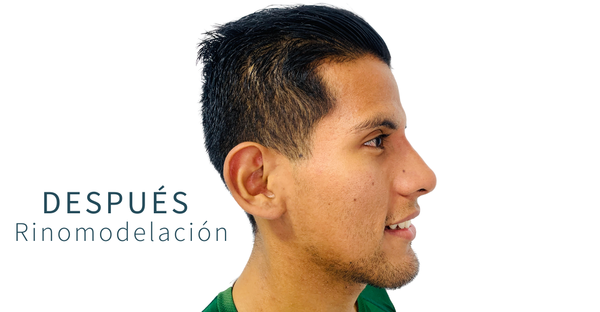 Before-Rinomodelación
