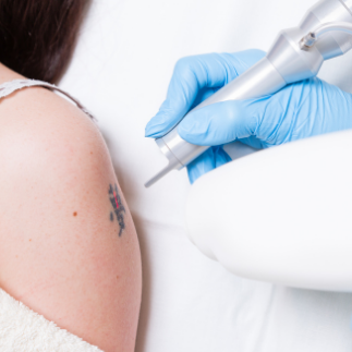 Eliminación de tatuajes Eliminación de tatuajes