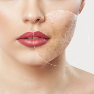 Secuelas de acné Secuelas de acné