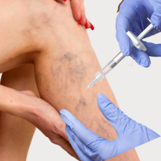 Eliminación de arañas vasculares Eliminación de arañas vasculares